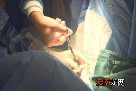 二胎剖腹产后做结扎手术