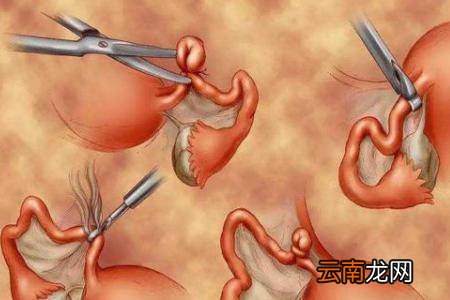 二胎剖腹产后做结扎手术