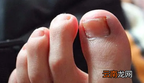 为什么年纪轻轻得了灰指甲